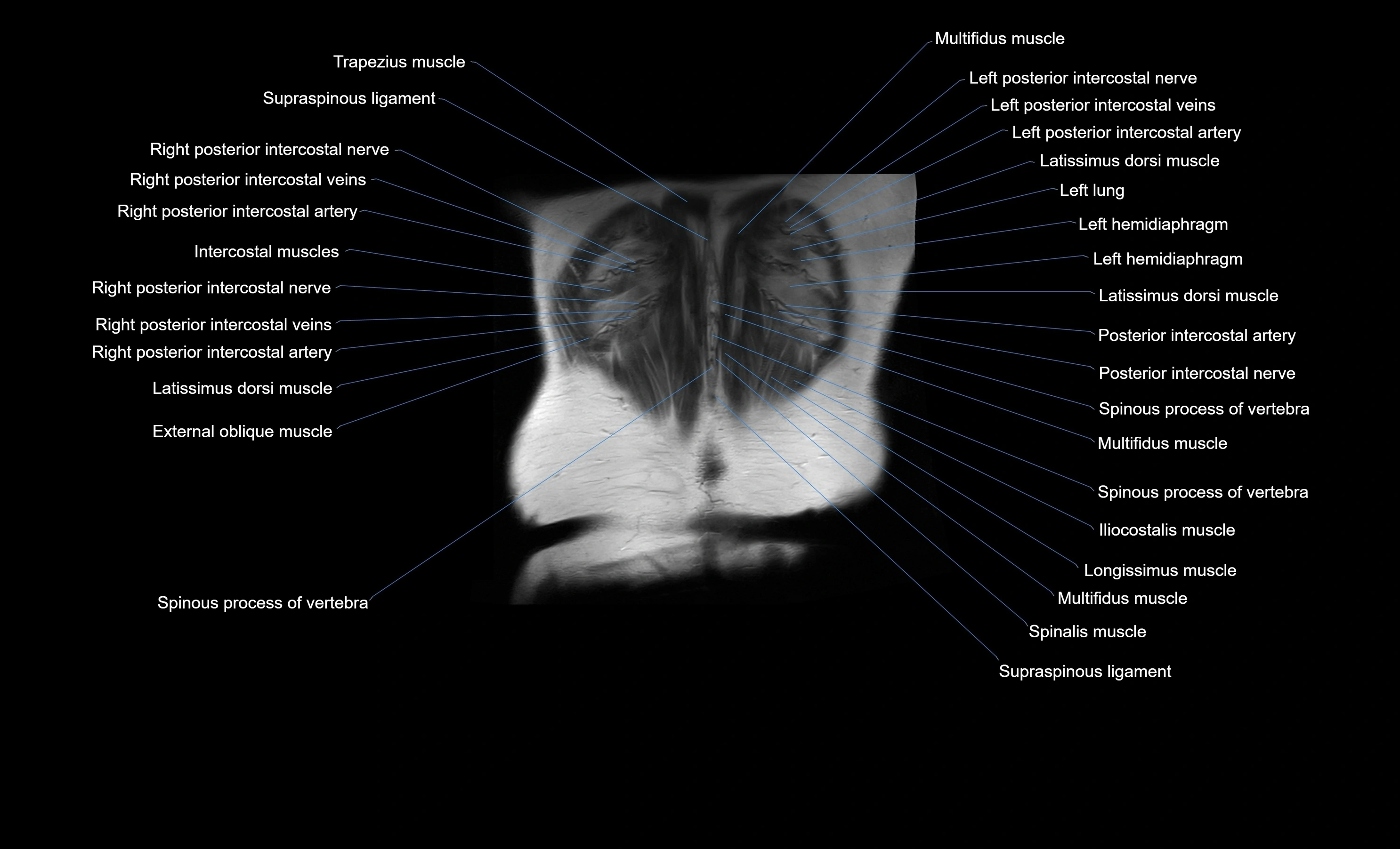 MRI Abdomen coronal labelled cross sectional anatomy radiology  image-img-00001-00054.webp